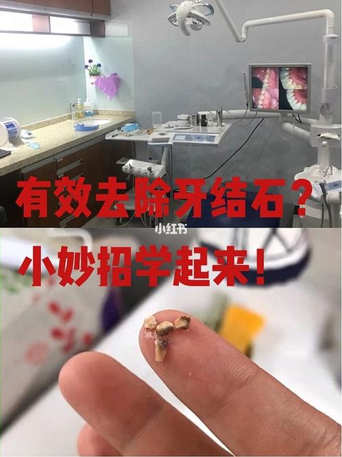 牙结石自己脱落小妙招